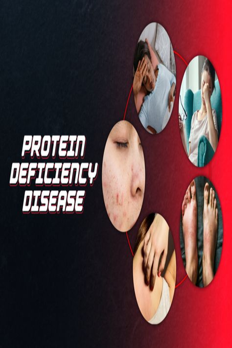 Protein Deficiency Diseases Meals With Protein, Protein Deficiency, Deficiency Diseases, The Signs, Our Body, To Miss, Disease, Signs