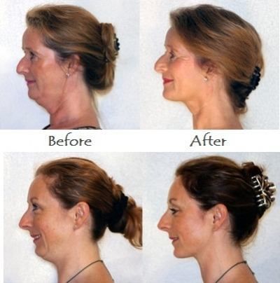 Naturally Lessen A Dual Chin: Keeping Your Face Fit And Lifted With Facial Rejuvenation Routines Saggy Cheeks, Defined Jawline, Face Lift Exercises, Beachbody Workout, Double Chin Exercises, Toning Exercises, Chin Exercises, Face Fat, Double Menton