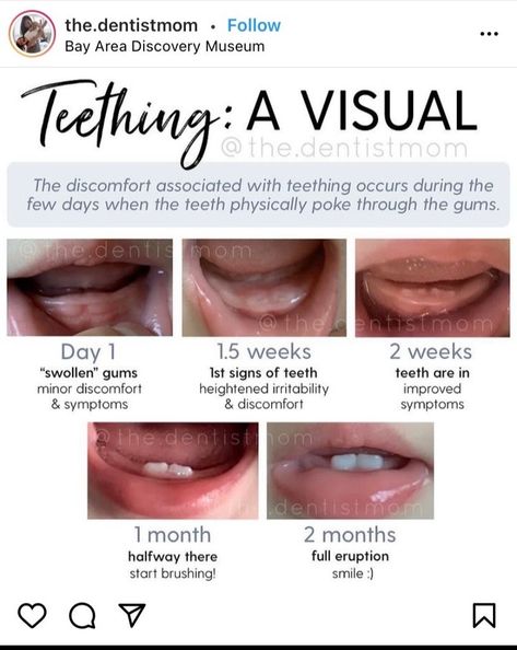 No teeth yet... are these teeth about to come through? - August 2020 Babies | Forums | What to Expect Teething Symptoms Baby, Teething Signs, Body Rash, Teething Symptoms, Teething Gums, No Teeth, Swollen Gum, Salivary Gland, Smart Parenting