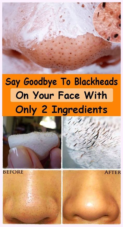 Many thanks for… Incredible information! To Remove Blackheads, Black Heads, Cold Sores Remedies, Remove Blackheads, Beauty Tips For Glowing Skin, Diy Remedies, Get Rid Of Blackheads, Many Thanks, Diy Skin Care