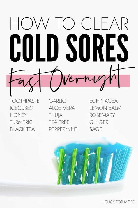 How to Clear Cold Sores Fast Cold Sore Remedy, Diy Cold Sore Remedy Fast, Cold Sore Remedy Quick Overnight, Cold Sore Remedy Fast, Cold Sore Remedy Overnight, Cold Sore Remedies, Natural Cold Sore Remedy, Home Remedies For Cold, Cold Sore Prevention