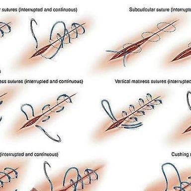 Medical Doctors | Different types of surgical sutures . #medicalstudent #doctor #surgery #surgeon #clinical #medicalschool | Instagram Surgical Suture, Medical Students, Doctor Medical, Medical School, Different Types, Surgery, Health Care, Medical, Science