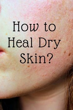 Tips to heal dry and itchy skin. Dry Skin Makeup, Brown Spots On Skin, Healing Dry Skin, Dry Skin On Face, Dry Skin Remedies, Combination Skin Type, Dry Itchy Skin, Skin Spots, Spots On Face