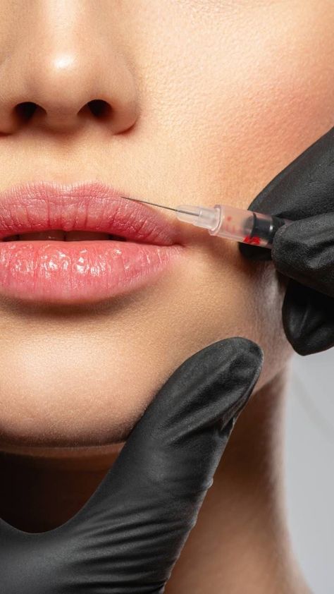 Botox Aesthetic Photography, Lip Injections Aesthetic, Armonizacion Facial, Injectables Aesthetic, Lip Filler Aesthetic, Botox Aesthetic, Botox Cost, Allergan Botox, Clinic Beauty