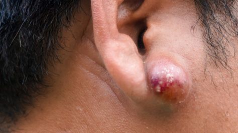 What Causes Lumps Behind the Ears? Lump Behind Ear, House Projects, The Ear, A Sign, Blackheads, Behind Ear Tattoo, Bump, Medical, Quick Saves