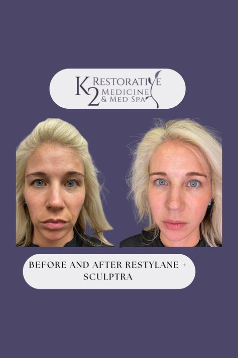 Before and After Restylane + Sculptra amazing Results Sculptra Before And After, Receding Chin, Common Myths, Med Spa, Natural Beauty, Medicine, Spa, Beauty, Nature