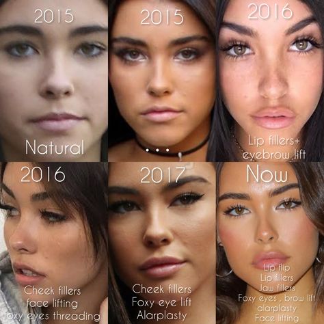 Madison Beer plastic surgery Madison Beer Plastic Surgery, Beer For Hair, Natural Summer Makeup, Eyebrow Lift, Madison Beer Style, Vibrant Makeup, Cheek Fillers, Facial Surgery, Facial Fillers