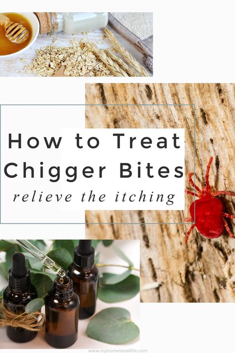 How to Treat Chigger Bites~ Over 17+ Remedies! - My Homestead Life Chigger Bite Remedy, Bite Relief, Homestead Life, Itch Relief, Camping Life, Health Diet, Herbal Remedies, Country Life, The Worst