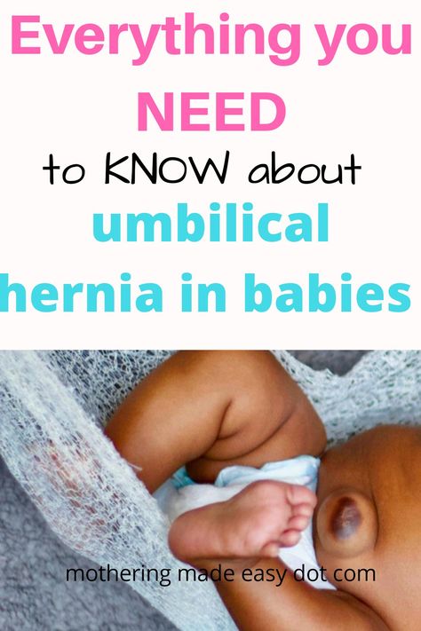 Some babies and infants develop umbilical hernia after the healing of umbilical cord. The consequences of having a hernia is often not serious except in cases where the intestine becomes obstructed. Low Birth Weight Babies, Nursery Must Haves, Baby Umbilical Cord, Sleep Essentials, Colicky Baby, 1 Year Baby, Starting A Family, Children Pictures, Weight Baby