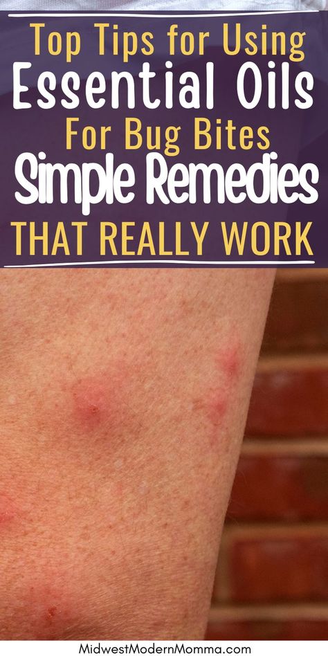 Essential oil remedies for bug bites showing red, irritated skin on an arm. Essential Oils For Bug Bites, Oils For Bug Bites, Bug Bite Swelling, Essential Oils Bug Bites, Essential Oil Remedies, Swelling Remedies, Bug Bite Itch, Itchy Bug Bites, Bug Bites Remedies