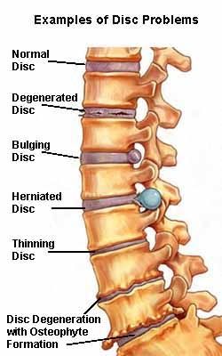 Lumbar Spondylosis & Prolapse Intervertebral Disc Homoeopathic Management Intervertebral Disc, Spinal Decompression, Bulging Disc, Spine Health, Spine Surgery, Human Skeleton, Sciatica Pain, Medical Anatomy, Chiropractic Care