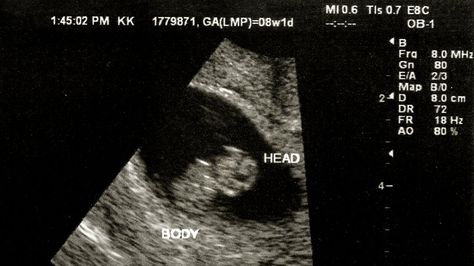 What Can I See On an 8-Week Ultrasound? 8 Week Ultrasound, Blighted Ovum, Conception Date, Pregnancy Test Results, Baby Ultrasound, Gestational Age, Belly Photos, Ectopic Pregnancy, Positive Pregnancy Test