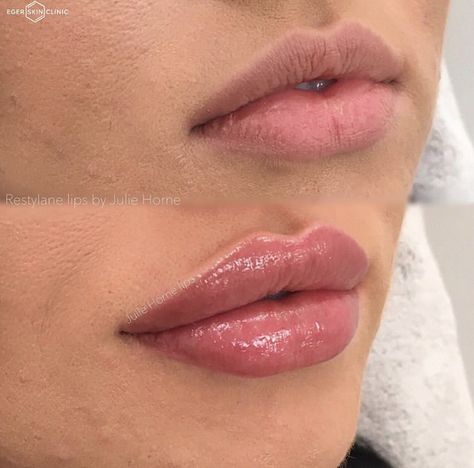 Lip Fillers Juvederm, Restylane Lips, Lip Permanent Makeup, Lips Inspiration, Permanente Make-up, Face Fillers, Botox Lips, Perfect Nose, Facial Fillers