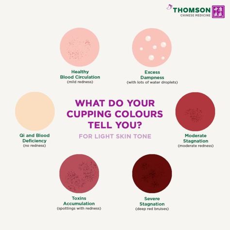 What Do Your Cupping Colours Tell You? | Thomson Chinese Medicine Lavender Health Benefits, Cupping Points, Qi Stagnation, Wet Cupping, Traditional Chinese Medicine Acupuncture, Chinese Cupping, Coffee Cupping, Hijama Cupping, Massage Therapy Business