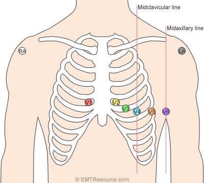 12-lead-ecg-placement Cardiac Physiologist, 12 Lead Ekg Placement, Ecg Placement, Ekg Placement, Lead Placement, Cardiac Dysrhythmias, Ekg Leads, Ekg Tattoo, Emt Study