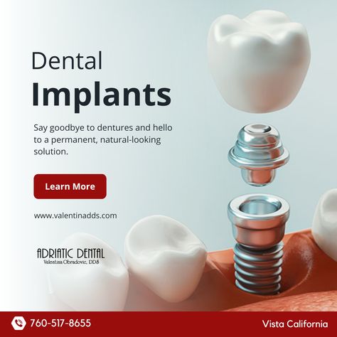 Dental implants look and feel like natural teeth. They are custom-made to match the color, shape, and size of the surrounding teeth, which can improve a person's smile and overall appearance. Call us ☎️ (760) 517-8655 Visit us at 👉🏼 https://buff.ly/3K3bArB #AdriaticDental #ValentinaObradovic #VistaDentist #VistaCA #DentalImplants Dental Implant Poster, Dental Clinic Creative Ads, Dentist Creative Ads, Dental Implants Creative Ads, Dental Clinic Ads, Dental Creative Ads, Dental Campaign, Implant Dental, Clove Dental