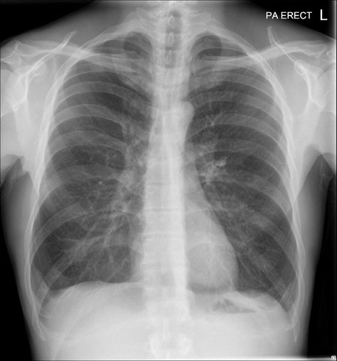 Normal chest x-ray with diaphragmatic slips. When the lungs are hyperexpanded it is important not to confuse blunting of a costophrenic recess due to diapragmatic slip for blunting due to a pleural effusion.    Normal chest x-ray with diaphragmatic slips | Radiology Case | Radiopaedia.org Respiratory Acidosis, Xray Art, Pleural Effusion, X-ray Images, Back Stretches For Pain, Preventative Health, Buddha Image, Money And Happiness, School Of Medicine