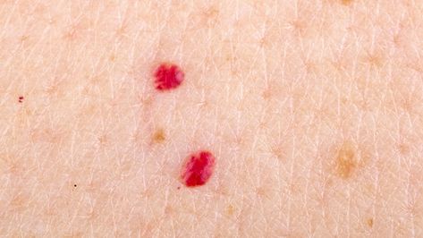 Here's What Some Of Those Red Marks On Your Skin Mean Cherry Angioma Removal, What Are Skin Tags, Red Skin Spots, Cherry Angioma, Best Shower Cleaner, Pillsbury Crescent Roll Recipes, Red Moles, Remove Skin Tags Naturally, Pillsbury Crescent