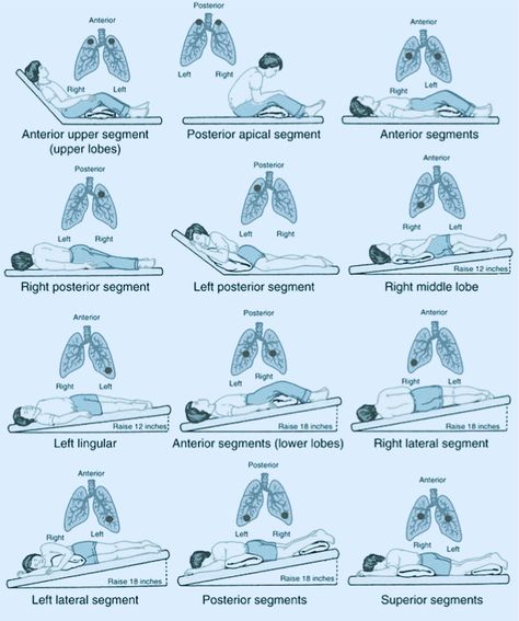 Chest Physiotherapy, Postural Drainage, Respiratory Therapist Student, Physiotherapy Student, Respiratory Therapy Student, Physical Therapy School, Physical Therapy Student, Physical Therapist Assistant, Physical Therapy Assistant