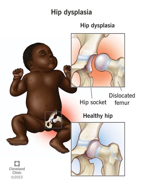 Does my baby have hip dysplasia? Hip Dislocation, Hip Problems, Hip Dysplasia, Cleveland Clinic, Signs And Symptoms, Medical Center, The Signs, Medical Professionals, Pediatrics