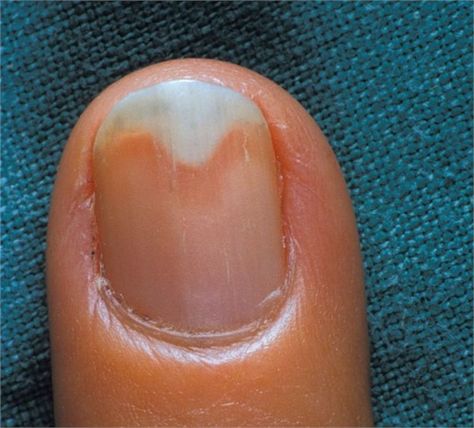 What Is Onycholysis? Nail Disorders, Nail Remedies, Split Nails, Fingernail Fungus, Nail Problems, Nail Fungus Remedy, Nail Infection, Fungal Nail, Nails Today