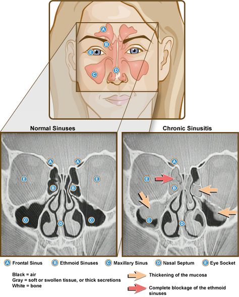 Front view illustration and side-by-side CT scans of normal and chronic sinusistis. Labeled: frontal sinus, ethmoid sinuses, maxillary sinus, nasal septum, eye socket. Credit: NIAID Mucus In Throat, Acute Sinusitis, Remedy For Sinus Congestion, Sinus Remedies, Getting Rid Of Phlegm, Home Remedies For Sinus, Maxillary Sinus, Sinus Congestion Relief, Chronic Sinusitis