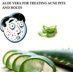 IS ALOE VERA GOOD FOR ACNE: REMEDIES FOR TREATING ACNE PITS AND HOLES WITH ALOE VERA Home Remedies For Pimples, Treating Acne, Pimples Remedies, Aloe Vera For Hair, Natural Acne Remedies, Skin Natural Remedies, Home Remedies For Acne, Acne Problem, Acne Scar Removal