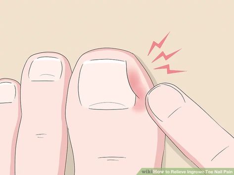 5 Ways to Relieve Ingrown Toe Nail Pain - wikiHow Toenail Pain, Infected Toenail, Nail Remedies, Nail Infection, Nail Fungus Remedy, Ingrown Toenail, Ingrown Nail, Fungal Nail, Brittle Nails