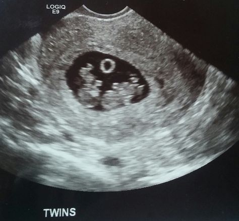 Are you pregnant with twins and wondering about what to do during the twins first trimester? We've got a great checklist to get you started! Twins Ultrasound, Pregnant Twins, 3 Months Pregnant, First Trimester Checklist, Twin Pregnancy Belly, Baby Ultrasound Pictures, Trimester Checklist, Twins Pregnancy, Pregnancy First Trimester