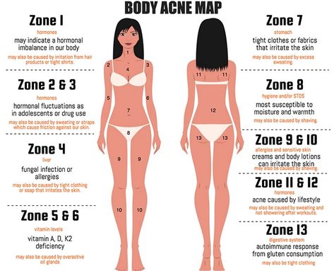 The Acne Map: What's The Meaning Behind Your Body Breakouts? - The Chalkboard Body Acne Map, Doterra Acne, Gesicht Mapping, Chest Acne, Face Mapping Acne, Face Mapping, Natural Acne, Body Acne, Acne Breakout