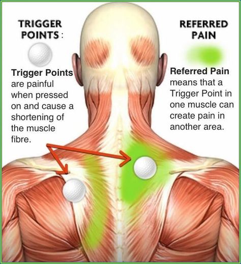 Massage Anatomy, Punkty Spustowe, Psoas Release, Referred Pain, Trigger Point Therapy, Trigger Point, Foot Reflexology, Neck Pain Relief, Neck And Shoulder Pain