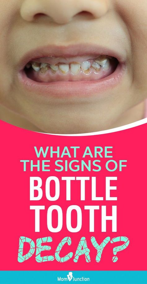 Nursing caries in infancy could damage deciduous teeth (milk teeth) and affect the eruption of permanent teeth. A dental checkup within six months of the first tooth’s eruption is advisable as a preventive measure. Fix Receding Gums, Home Remedies For Cavities, Baby Bottle Tooth Decay, Dental Business, Milk Teeth, Discolored Teeth, Kids Teeth, Teeth Health, Oral Care Routine