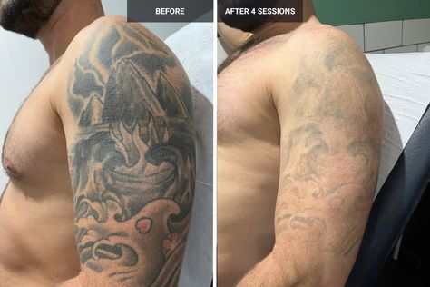 Witness astonishing changes with laser tattoo removal before and after. Discover the journey to tattoo-free skin. - #Beforeandaftertattooremoval #Comparingtattoobeforeandafterremoval #Comparisonoftattooappearance #Evolvingtattooappearance #Lasertattootransformation #Progressionoftattooerasure #Tattoochangefromstarttofinish #Tattoodisappearancetransformation #Tattoofadingprogress... Laser Tattoo Removal Before And After, Tattoo Removal Before And After, Tattoo Free, Tattoo For Boyfriend, Tattoo Minimal, Sketches Ideas, Web Tattoo, Omerta Tattoo, C Tattoo