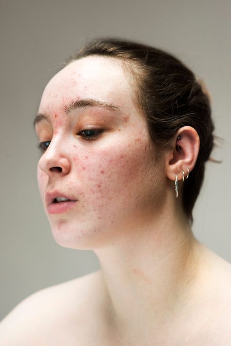 8 Raw Photos Of Young Women With Common Skin Conditions+#refinery29uk Acne Pictures, Lemon Face Mask, 얼굴 그리기, Face Drawing Reference, Body Photography, Raw Photo, Human Reference, Face Photography, Raw Beauty