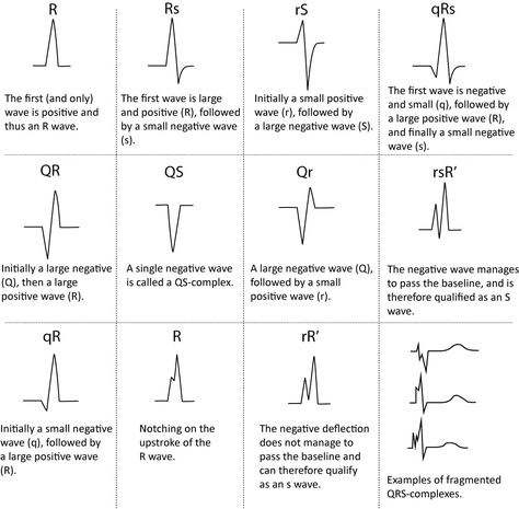 ECG interpretation: Characteristics of the normal ECG (P-wave, QRS complex, ST segment, T-wave) – ECG learning Nursing Cardiac, Normal Ecg, Ekg Rhythms, Cardiology Nursing, Ekg Interpretation, Ecg Interpretation, Paramedic School, Medical Mnemonics, Medical Notes