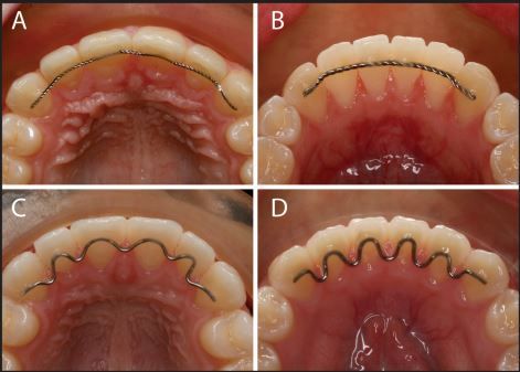 What is a permanent retainer? A fixed retainer, also known as a permanent or bonded retainer, is a wire that is glued to the lingual (tongue side) of the teeth. Contact to best orthodontist for Bonded Retainer or Replacement Retainer. Teeth Makeover, Permanent Retainer, Retainer Teeth, Future Dentist, Dental Hygiene Student, Orthodontic Appliances, Dental Videos, Dental Hygiene School, Brace Face