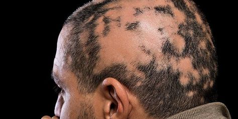 alopecia areata facts Alopecia Symptoms Signs, Alopecia Photography, Alopecia Causes, Alopecia Hairstyles, Thick Hair Remedies, Scalp Micropigmentation, Vip Lounge, Hair Remedies For Growth, Pattern Baldness