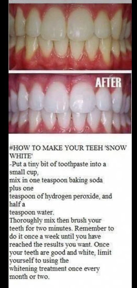 Make Teeth Whiter, Baking Soda Teeth, Natural Teeth Whitening Diy, Obličejové Masky, Baking Soda Teeth Whitening, Teeth Whitening Homemade, Baking Soda And Lemon, Teeth Whitening Remedies, Teeth Whitening Diy