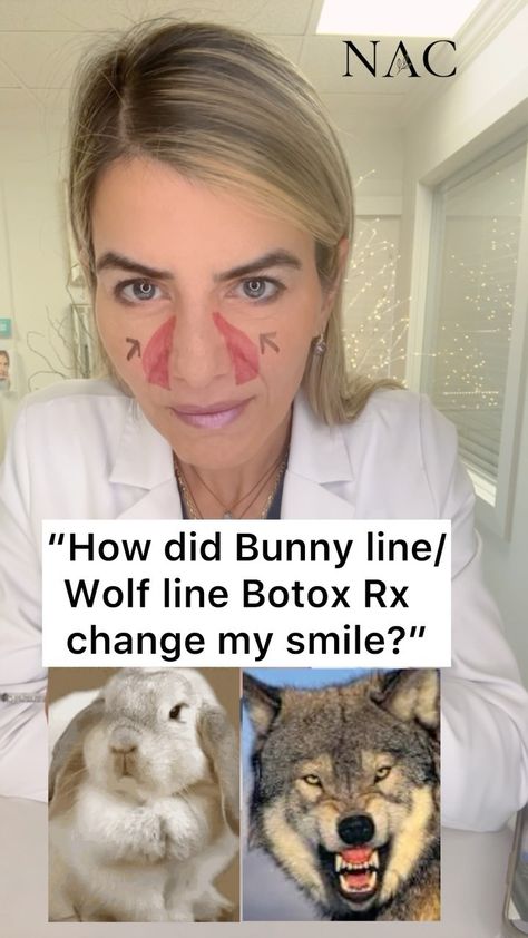 #bunnylines #wolflines #bunnylinebotox #botox #botoxtraining #drbitafarrell #naturalaestheticscenter | Instagram Bunny Lines Botox Before And After, Botox Injection Sites, Botox Training, Botox Before And After, Laugh Lines, Botox Fillers, Iv Therapy, Botox Injections, Spa Decor