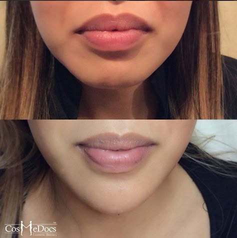 Kylie Jenner Plastic Surgery, Dental Makeover, Chin Filler, V Shape Face, Chin Augmentation, Chin Implant, Facial Procedure, Face Surgery, Facial Fillers