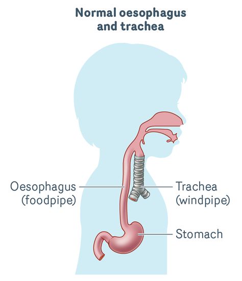 Normal-oesophagus-trachea Trachea Anatomy, Gastrostomy Tube, Swallowing Problems, Large Bowel, Medical Library, Squamous Cell, Reflux Symptoms, Pediatric Care, Hard Breathing