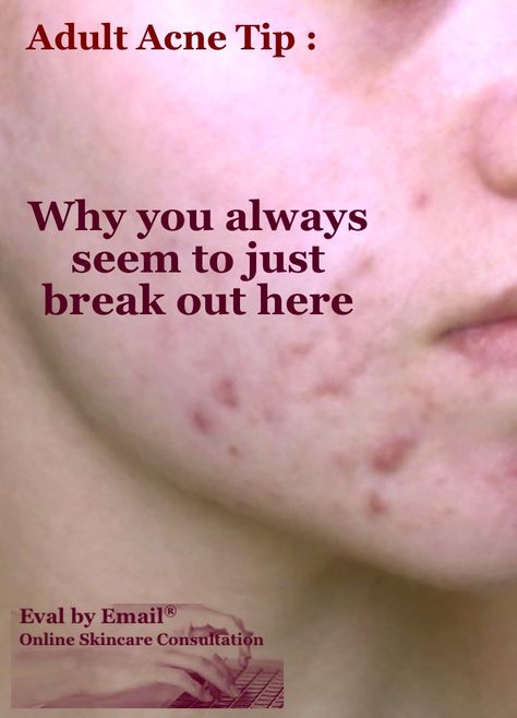 #Adult #Acne Tip : Often #breakouts along the sides of the chin and jaw are described as "#hormonal". But, before I explore internal conditions or even diet, I check to see if one side is more broken out than the other. If it is, it means #pore #clogging materials are being pressed in, and friction is inflaming the pores at the same time. What is this person leaning on?? Acne On Jawline Meaning, How To Apply Blusher, Hormonal Acne Remedies, Blind Pimple, Pimples Under The Skin, Acne Overnight, Natural Acne Remedies, Acne Causes, Hormonal Acne