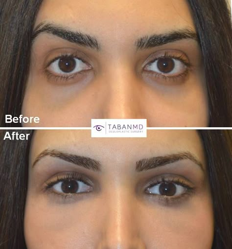 Eye Enlargement Surgery, Orbital Decompression Surgery, Eye Makeup For Bulging Eyes, Upper Eyelid Filler, Under Eye Surgery Before And After, Almond Eye Surgery, Canthoplasty Before And After, Belfaroplasty Eyes, Orthognathic Surgery Before And After