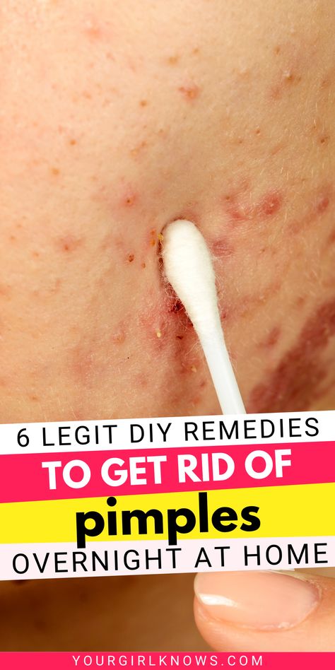 How to get rid of acne overnight Get Rid Of Pimples Overnight, Rid Of Pimples Overnight, Rid Of Acne Overnight, Get Rid Of Acne Overnight, Redness Pimple, Back Acne Remedies, Blind Pimple, Get Rid Of Pimples, Rid Of Pimples