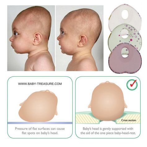 BABY-TREASURE.COM on Instagram: “The head of your baby is dented? This is the result of a constant pressure on one spot. (Flat Head Syndrome) please watch the video to know…” Flat Head Syndrome, Palawan Philippines, Philippines Travel, Mom Baby, The Skull, Support Pillows, Baby Head, Flat Head, Baby Fever