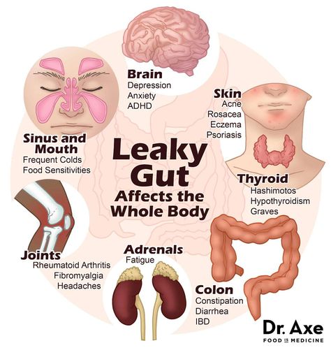 Heal Leaky Gut Naturally, Low Energy Remedies, Leaky Gut Symptoms, Leaky Gut Diet, Heal Leaky Gut, Gut Healing, Autoimmune Disorder, Leaky Gut, Food Sensitivities