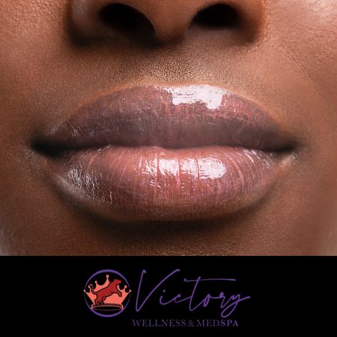 Lip Filler and Lip Flip. Victory Cincinnati www.victorywellness.com 513-936-3065 Victory Naples www.victorywellnessnaples.com 239-307-7087 #restylane #laser #antiaging #prp #toxinabotulinica #filler #beauty #microneedling #victory #medspa #dysport #estetica #lips #juvederm #botox #cincinnati #naples #fillers #skincare #aesthetic #allergan #aesthetics #lipfillers #skin #hydrafacial #oshot #pshot #facial #dermalfillers #lipfiller Lip Flip, Hydra Facial, Lip Filler, Skincare Aesthetic, Pregnancy Health, Dermal Fillers, Lip Fillers, Double Chin, Med Spa