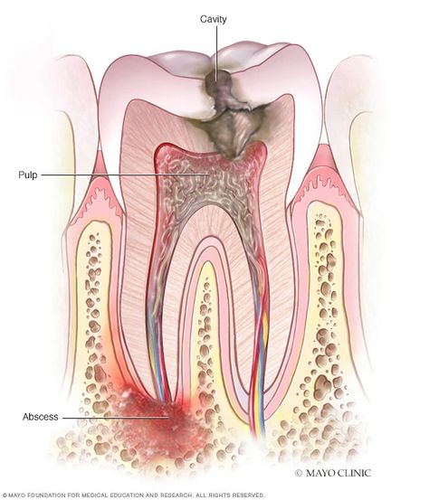 Tooth abscess - Symptoms and causes - Mayo Clinic Abscess Tooth, Tooth Pain Remedies, Wisdom Teeth Pain, Teeth Images, Teeth Remedies, Dental Images, Tooth Infection, Dental Posters, Remedies For Tooth Ache