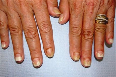 Nail Disorders, Nail Remedies, Antifungal Cream, Under The Microscope, Nail Problems, Nail Infection, Nail Bed, Ingrown Toe Nail, Toenail Fungus