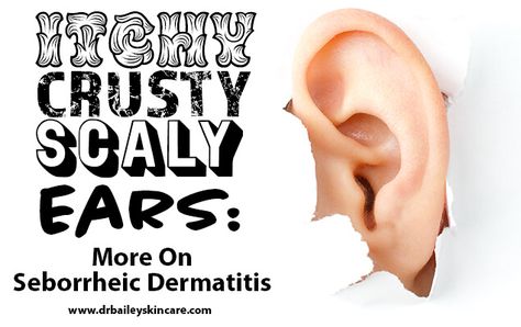 Itchy Ears Remedies, Itchy Ears, Cynthia Bailey, Dandruff Remedy, Dry Itchy Scalp, Dry Flaky Skin, Itching Skin, Scaly Skin, Dry Skin Remedies